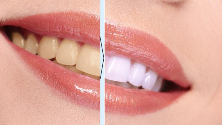 Whitening Pen – Quick, Portable Plaque & Stain Remover